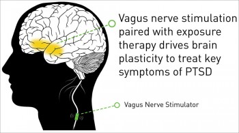 Study: Vagus Nerve Stimulation Shows Progress Against PTSD Symptoms